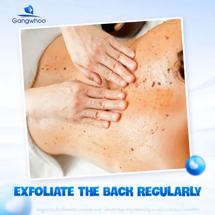 11+ Effective and Safe Back Acne Treatments You Can Do at Home