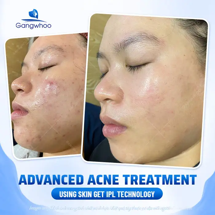 9+ Effective and Fast Methods to Treat Hormonal Acne 2 9+ Effective and Fast Methods to Treat Hormonal Acne