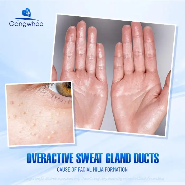 9+ Safe and Fast Methods to Treat Syringoma on the Face