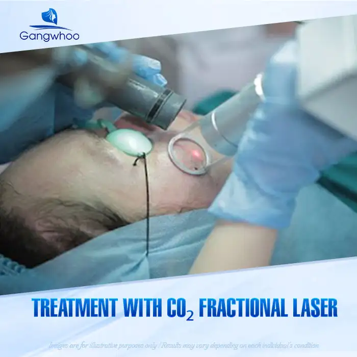 9+ Safe and Fast Methods to Treat Syringoma on the Face