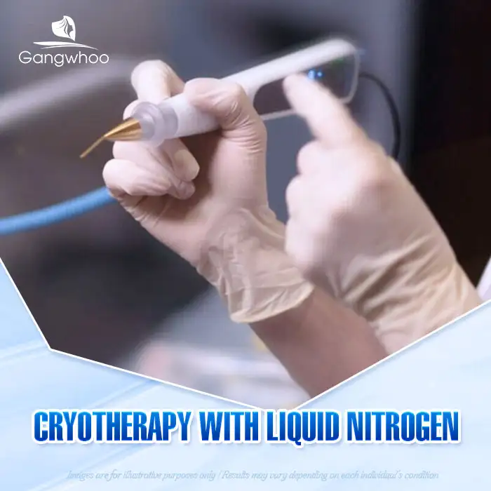 9+ Safe and Fast Methods to Treat Syringoma on the Face