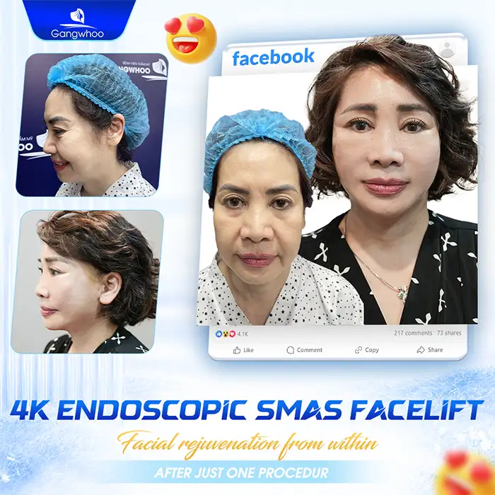 How Long Does Facial Thread Lifting Last? How to Maintain Long-Lasting Results?