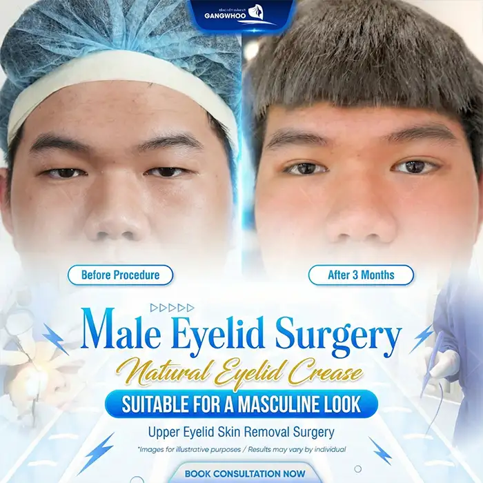 How much does double eyelid surgery for men cost? Updated latest price list 2025