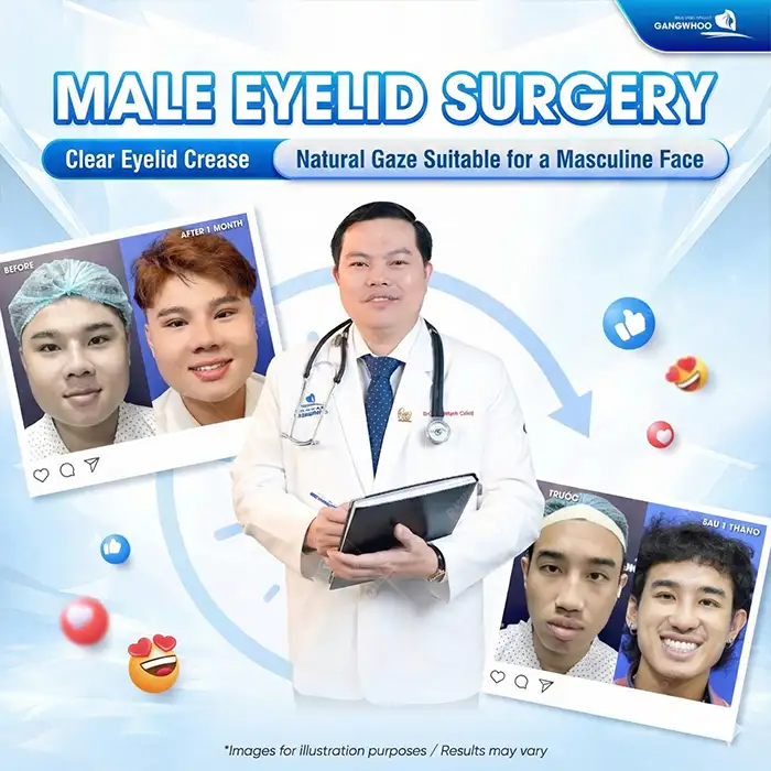 How much does double eyelid surgery for men cost? Updated latest price list 2025