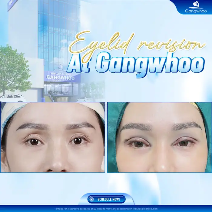 Can failed double eyelid surgery be corrected? What are the effective solutions?