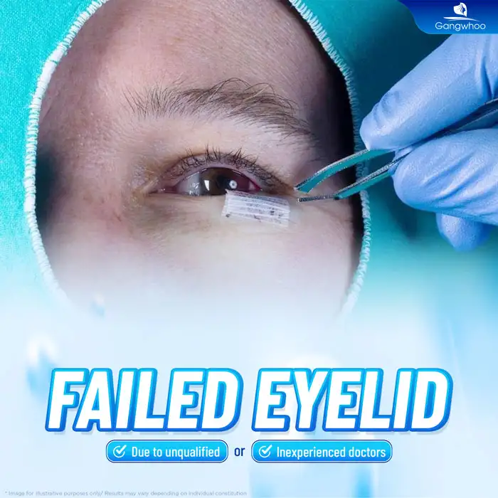 Can failed double eyelid surgery be corrected? What are the effective solutions?