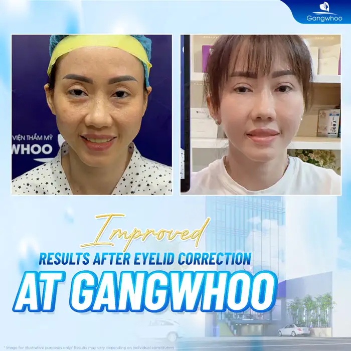 Can failed double eyelid surgery be corrected? What are the effective solutions?