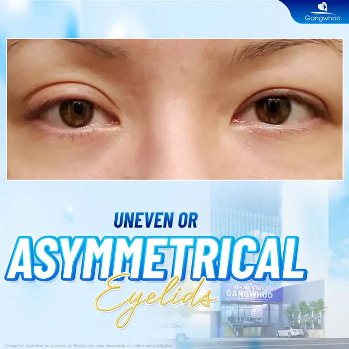 Can failed double eyelid surgery be corrected? What are the effective solutions?