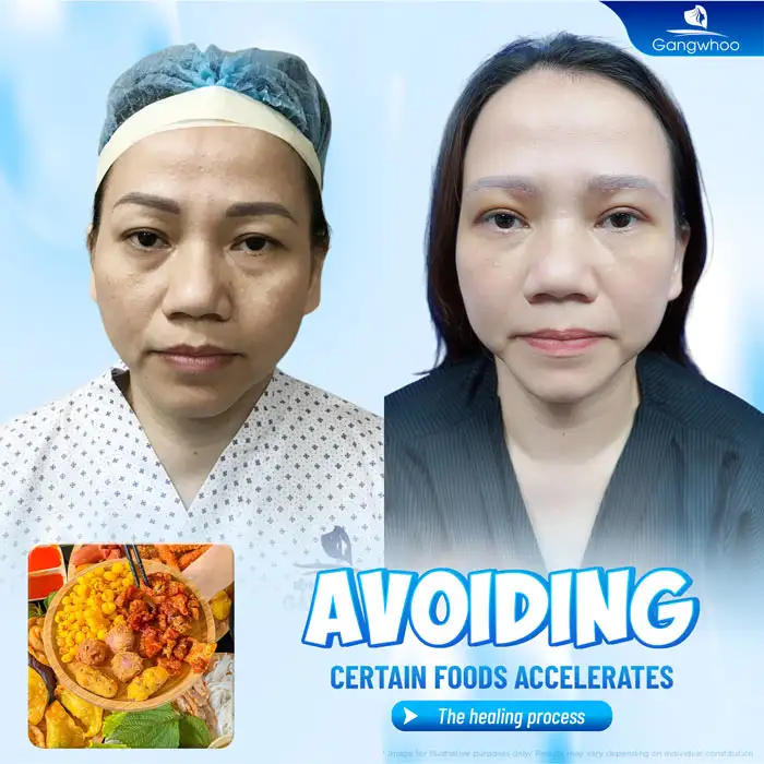 How long should you avoid certain foods after eyelid surgery? What should you eat after double eyelid surgery?
