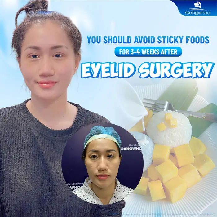 How long should sticky rice be avoided after double eyelid surgery? Why is it necessary to avoid sticky rice?