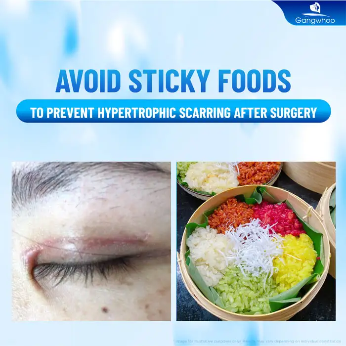 How long should sticky rice be avoided after double eyelid surgery? Why is it necessary to avoid sticky rice?
