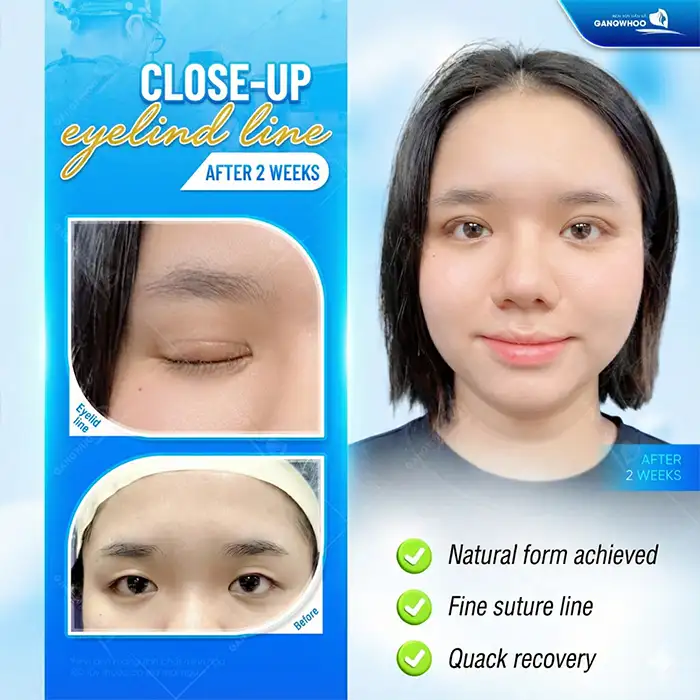 What Is “Smiling Eye” Double Eyelid Surgery? Who Is Suitable for Smiling Eye Eyelid Surgery