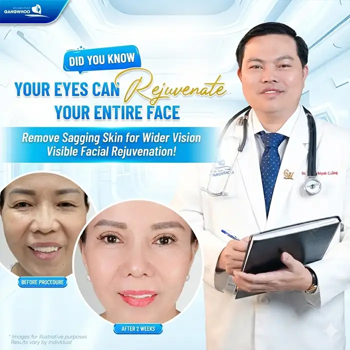 What Is “Smiling Eye” Double Eyelid Surgery? Who Is Suitable for Smiling Eye Eyelid Surgery