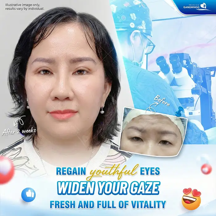What Is “Smiling Eye” Double Eyelid Surgery? Who Is Suitable for Smiling Eye Eyelid Surgery