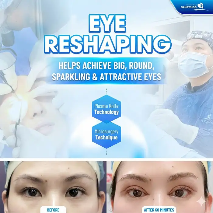 What Is “Smiling Eye” Double Eyelid Surgery? Who Is Suitable for Smiling Eye Eyelid Surgery