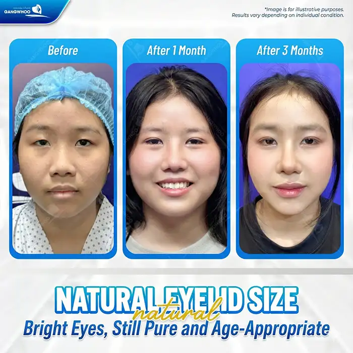 What is Mini Deep 6D Eyelid Surgery? Advantages and Disadvantages of This Method