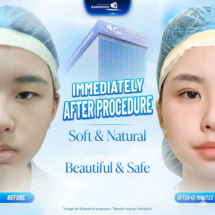 What is Mini Deep 6D Eyelid Surgery? Advantages and Disadvantages of This Method