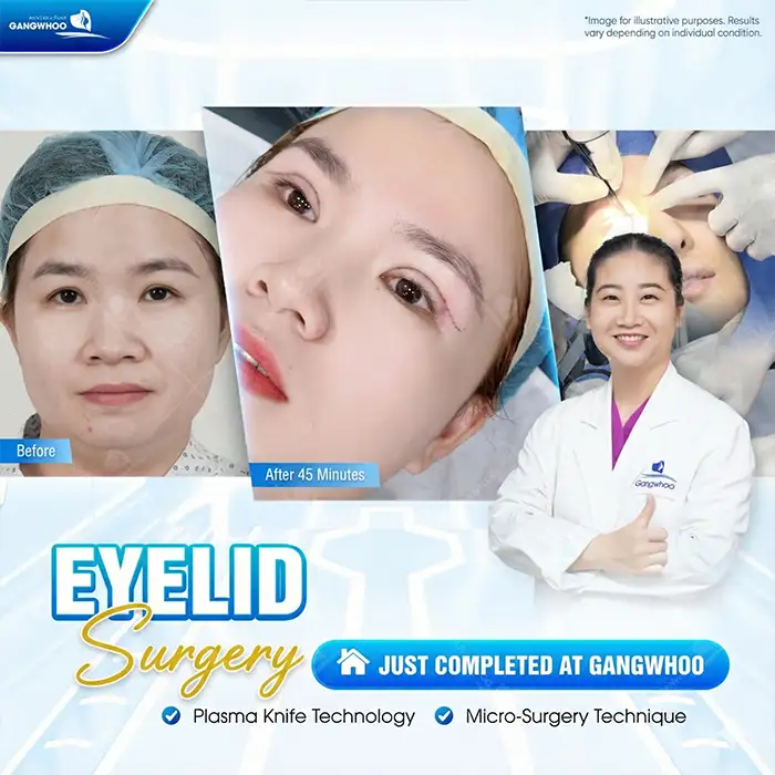 What is Mini Deep 6D Eyelid Surgery? Advantages and Disadvantages of This Method