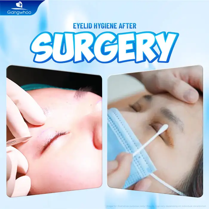 Proper Eye Care After Double Eyelid Surgery to Promote Fast Recovery