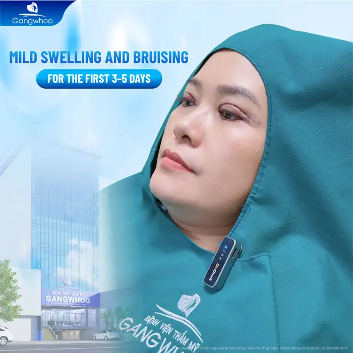 Proper Eye Care After Double Eyelid Surgery to Promote Fast Recovery