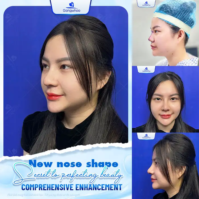 Can people prone to keloid scarring undergo nose augmentation, and are there any risks?