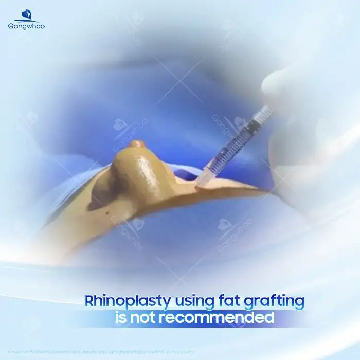 Should you consider rhinoplasty using autologous fat? Are there any potential complications?