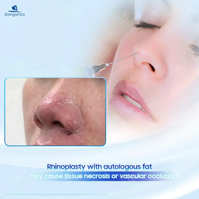 Should you consider rhinoplasty using autologous fat? Are there any potential complications?