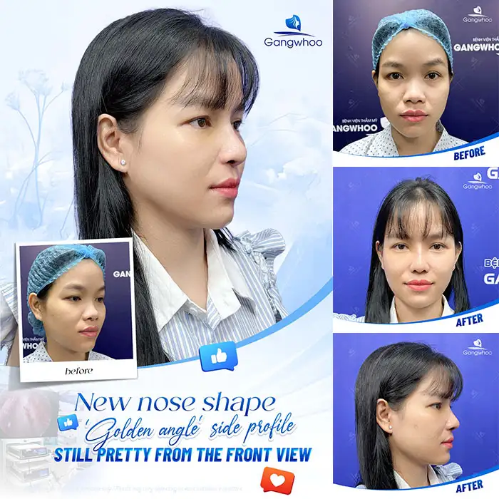 Should you choose Korean rhinoplasty? Is Korean rhinoplasty good?