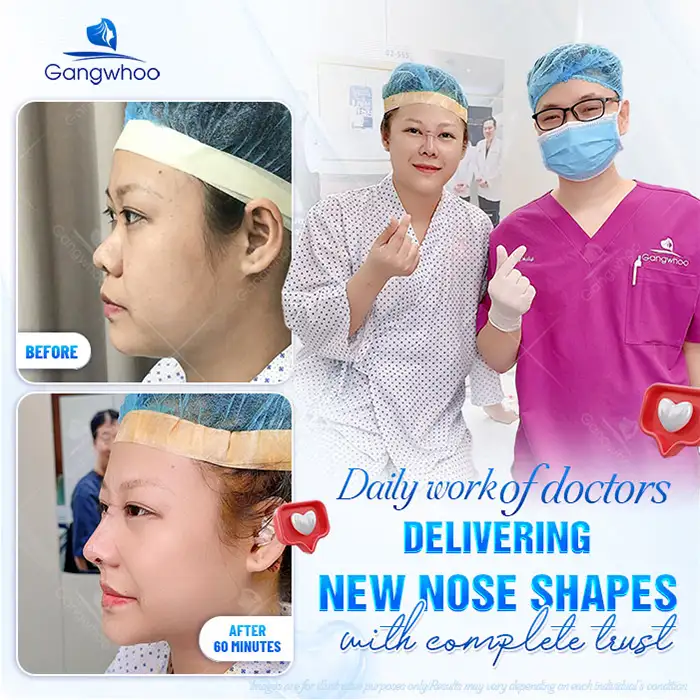 Should you choose Korean rhinoplasty? Is Korean rhinoplasty good?