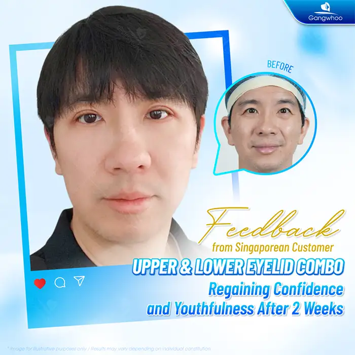 Should men get eyelid surgery? What are the benefits?