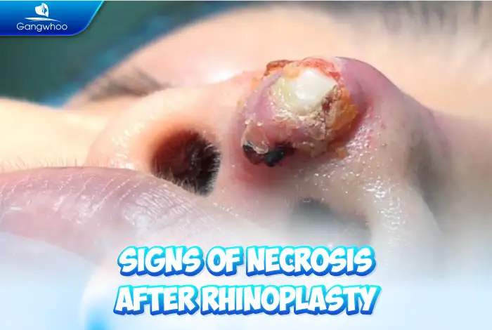 What are the signs of nasal necrosis after rhinoplasty? How should it be managed? 1 What are the signs of nasal necrosis after rhinoplasty? How should it be managed?
