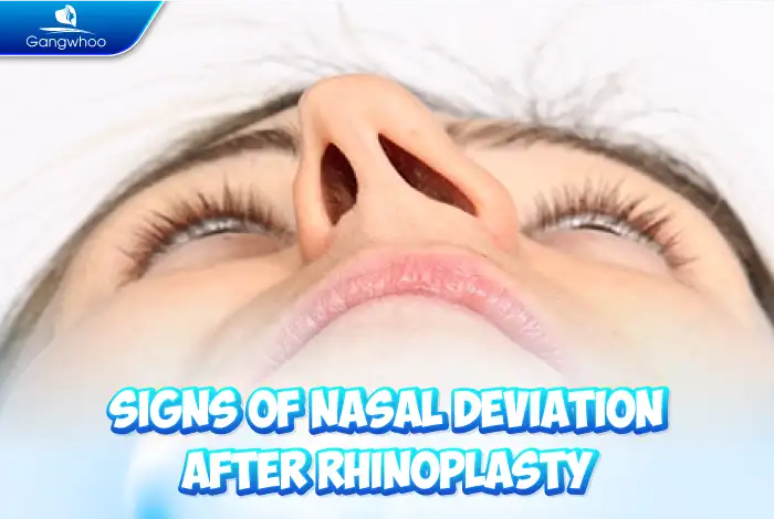What Are the Signs of a Crooked Nose After Rhinoplasty? How Can It Be Corrected?