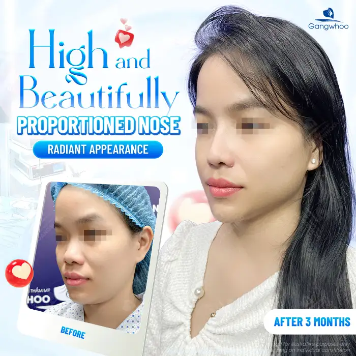 How much does 4D structural rhinoplasty cost? Updated latest price list 2025