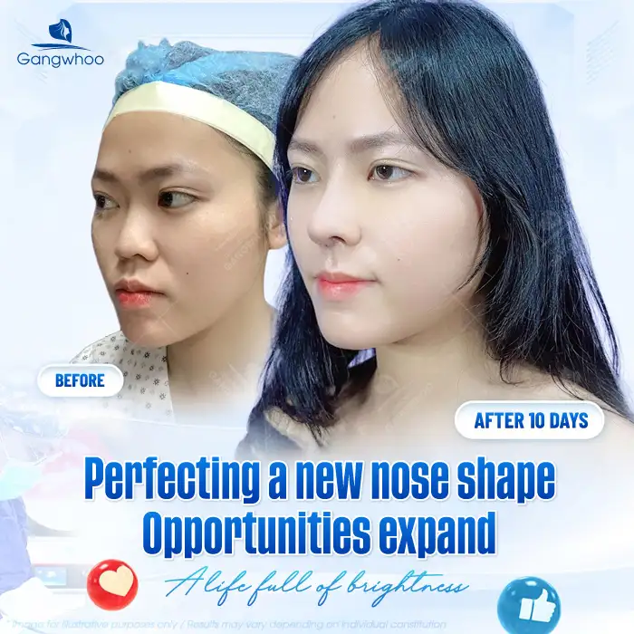 How much does 4D structural rhinoplasty cost? Updated latest price list 2025
