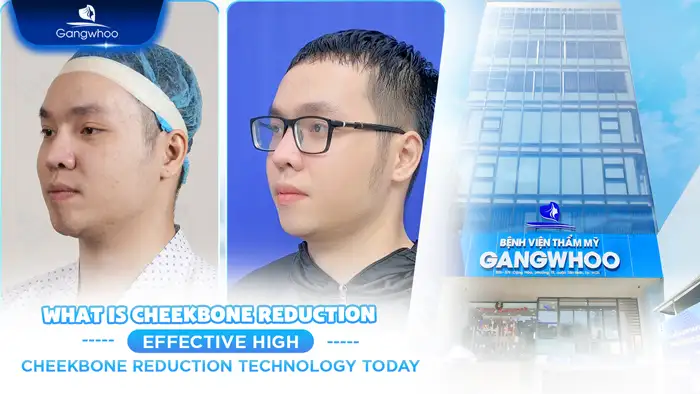 What Is Cheekbone Reduction? Effective High Cheekbone Reduction Technology Today