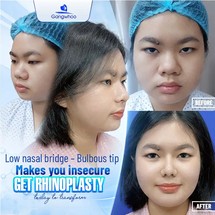 Is it possible to simulate rhinoplasty results before the procedure?