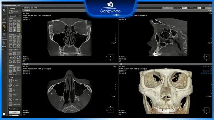 Is it possible to simulate rhinoplasty results before the procedure?