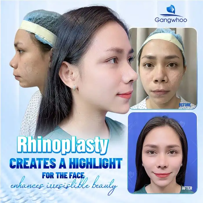 What Is Nasal Tip Elevation? Which Cases Is This Method Suitable For?