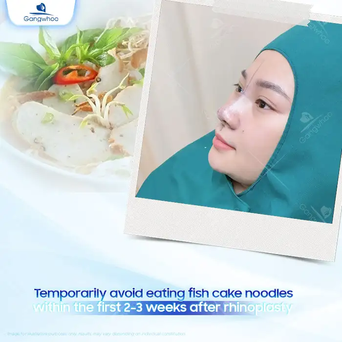 Can you eat fish cake noodle soup after rhinoplasty? Does it cause complications?