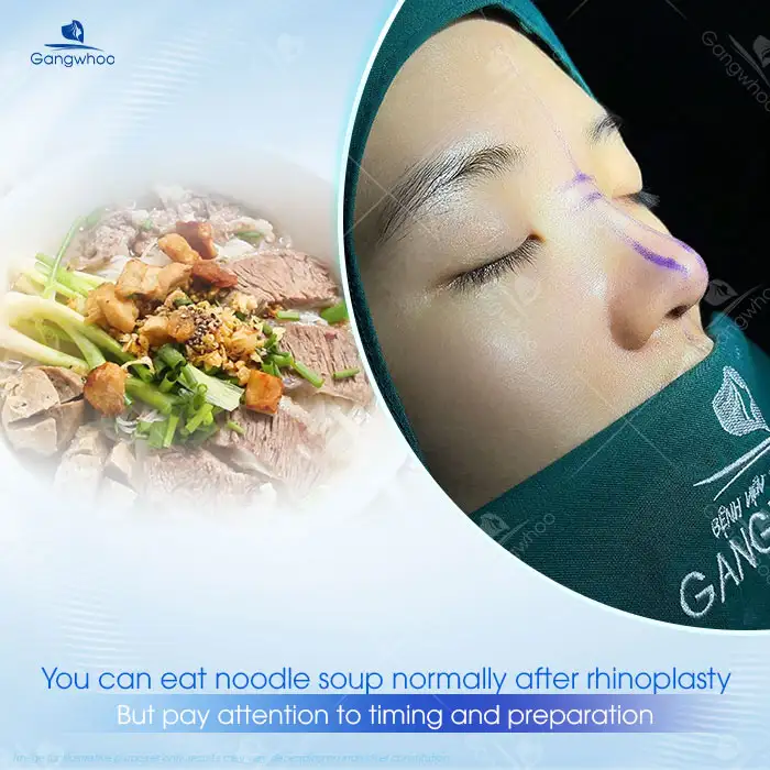 Can you eat hu tieu after nose augmentation? Notes when eating hu tieu after nose augmentation