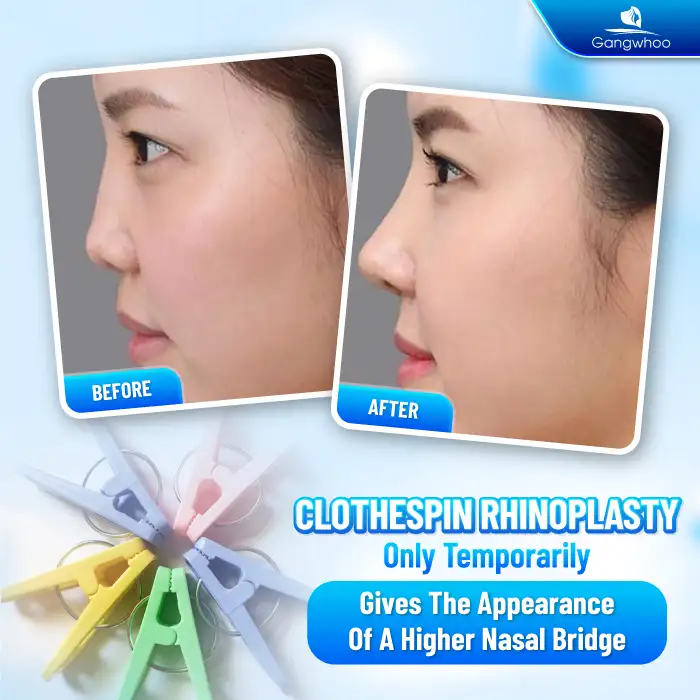 Is nose lifting with a clothespin safe? Can it increase the height of the nasal bridge? 2 Is nose lifting with a clothespin safe? Can it increase the height of the nasal bridge?