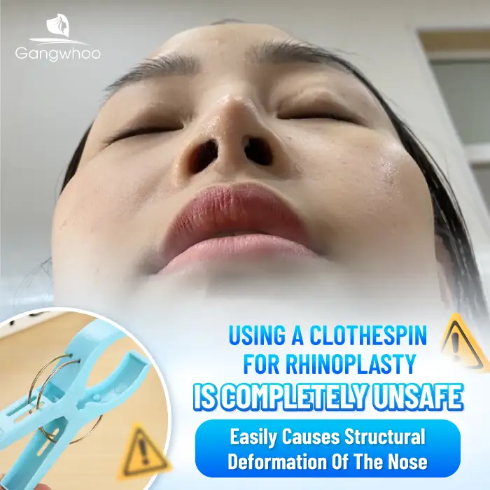 Is nose lifting with a clothespin safe? Can it increase the height of the nasal bridge? 1 Is nose lifting with a clothespin safe? Can it increase the height of the nasal bridge?
