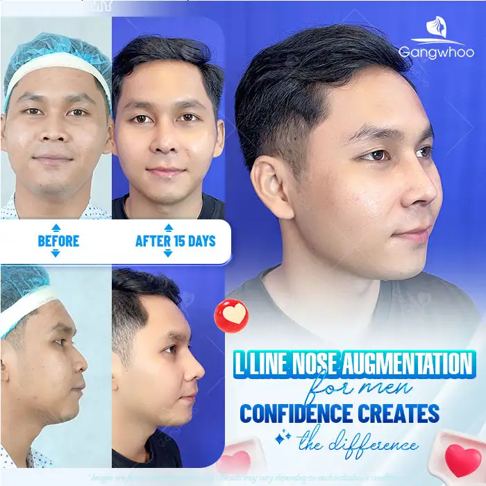 How long does autologous cartilage rhinoplasty last? Factors determining durability