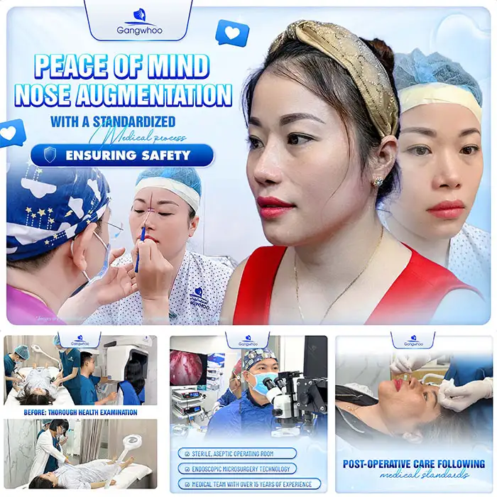 How long does autologous cartilage rhinoplasty last? Factors determining durability