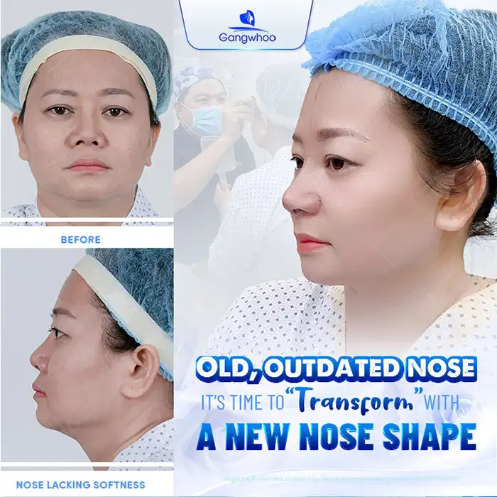 Should rhinoplasty be performed using autologous cartilage or synthetic cartilage? Which type of cartilage is better?