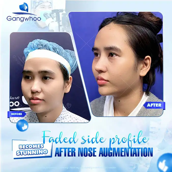 Should rhinoplasty be performed using autologous cartilage or synthetic cartilage? Which type of cartilage is better?