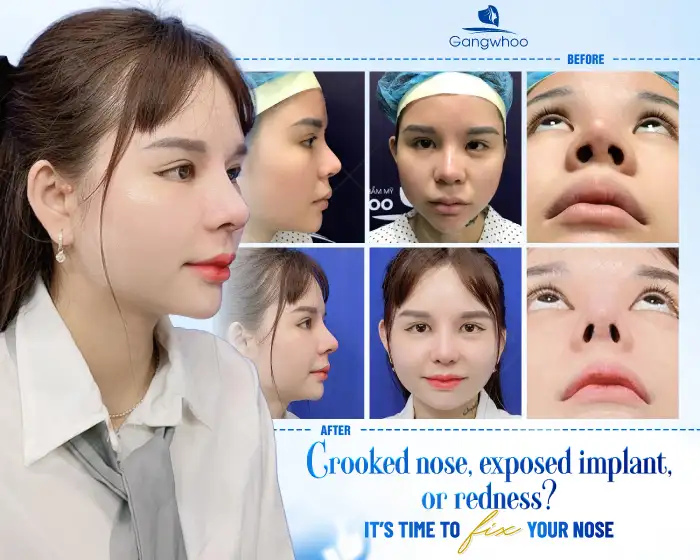 How long after rhinoplasty can revision surgery be performed? In which cases is revision necessary?