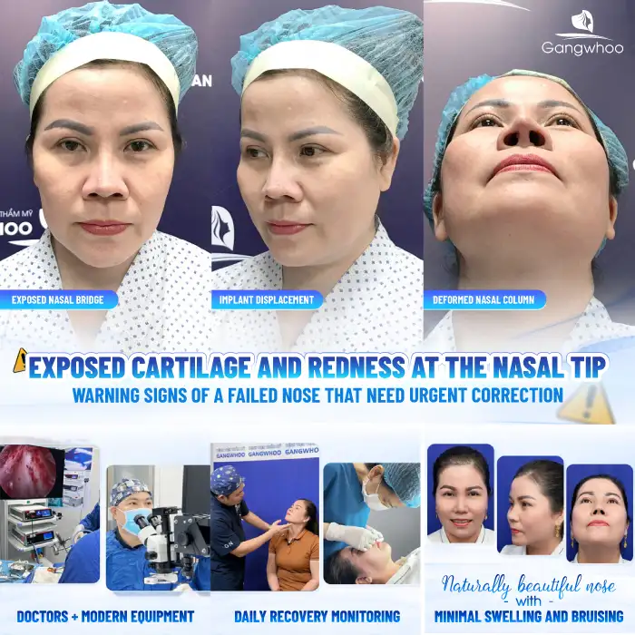 How long after rhinoplasty can revision surgery be performed? In which cases is revision necessary?