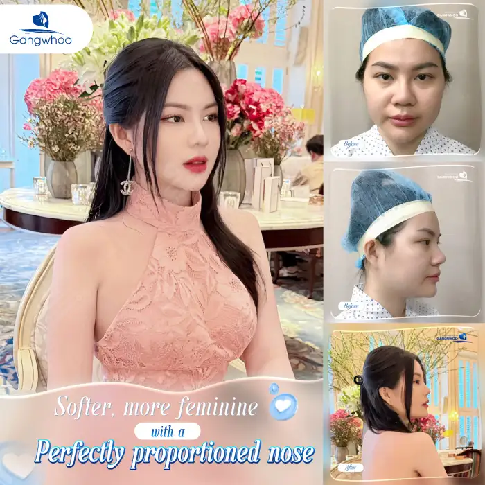 What Is Barbie Line Rhinoplasty? Should You Choose Barbie Line or S-Line Rhinoplasty?