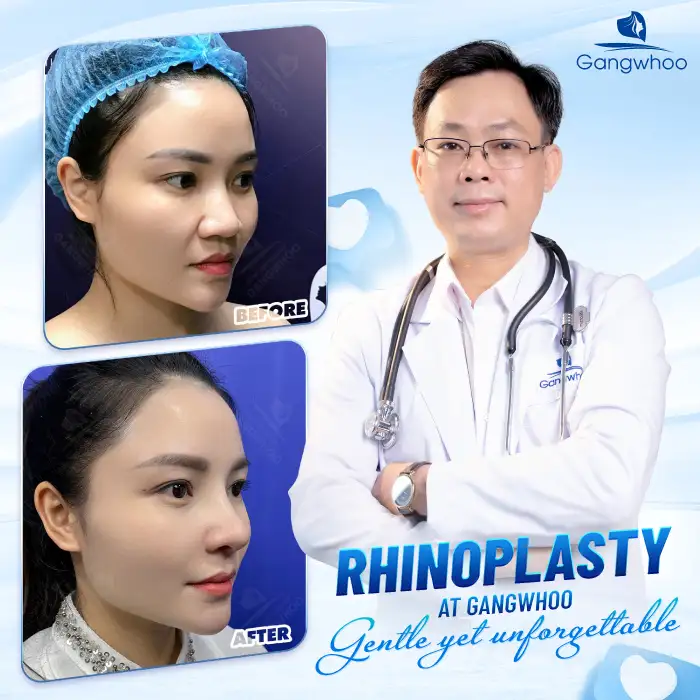 What Is Barbie Line Rhinoplasty? Should You Choose Barbie Line or S-Line Rhinoplasty?